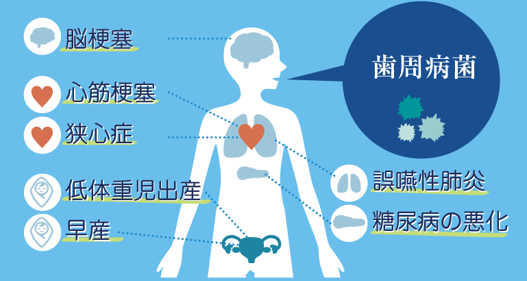 歯周病菌は脳梗塞、心筋梗塞、狭心症、誤嚥性肺炎、糖尿病の悪化、低体重児出産、早産など全身に影響を及ぼします