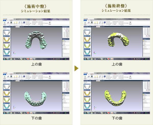 アライナーCAD/CAM技術シュミレーション画面